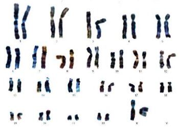 Le caryotype d'une femme (XX) Le caryotype d'une femme (XX)