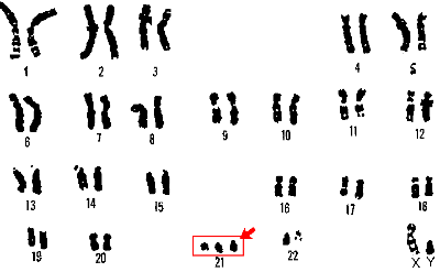 Caryotype d'un enfant atteint du syndrome de Down Caryotype d'un enfant atteint de trisomie 21